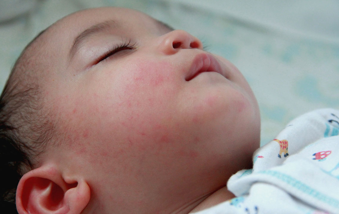 Eczema in Children – Overview, Tests, and Beneficial Foods